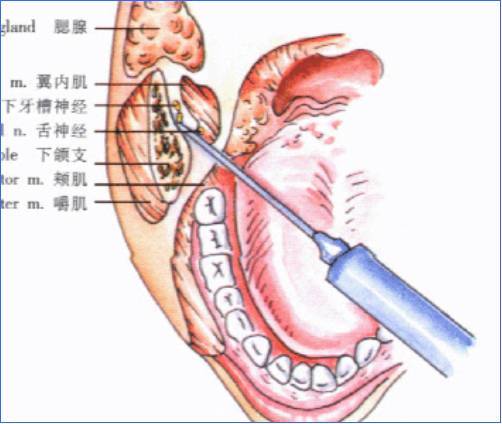 牙科必懂的口腔區域性麻醉