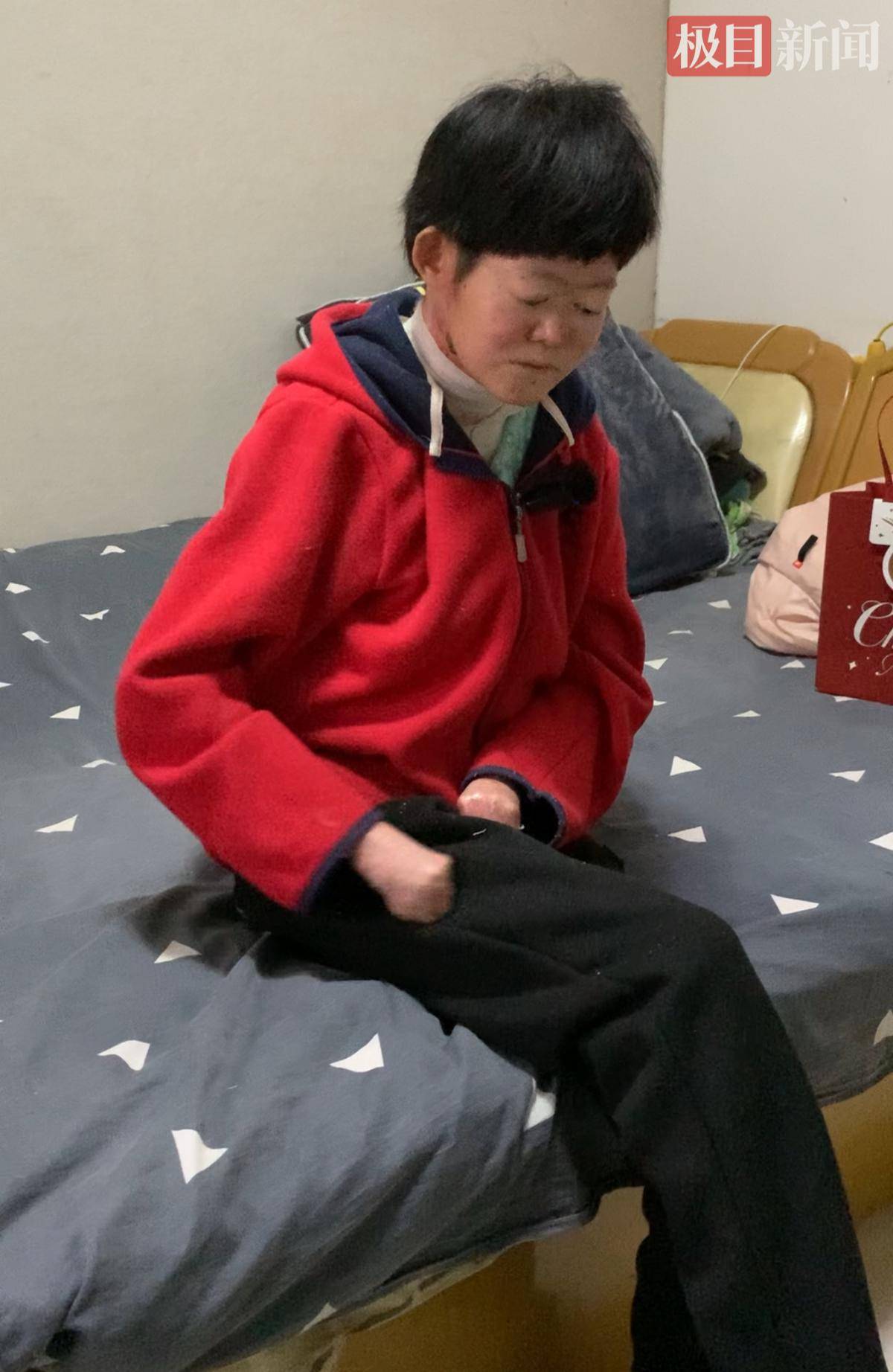 24歲“蝴蝶寶貝”小學成績曾名列前茅，初中畢業後身體無法支撐正常學習，曾一度癱瘓在床